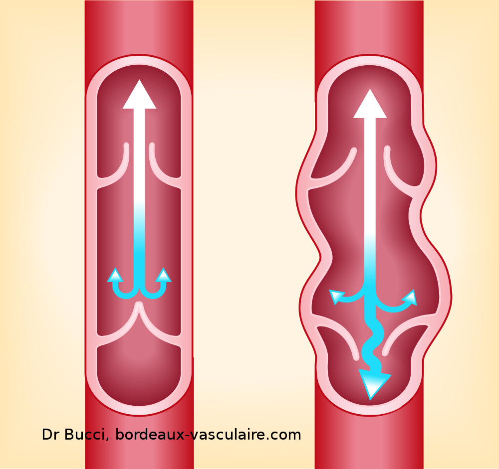 Varices2