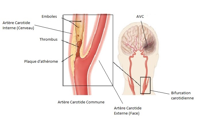 bifurcation carotide