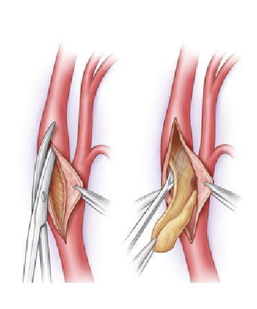 thromboendarterectomie